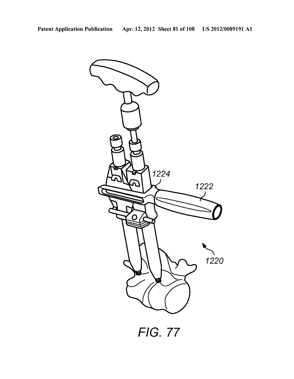 METHODS FOR STABILIZING BONE STRUCTURES - diagram, schematic, and image 82