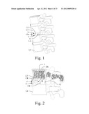 LORDOTIC EXPANDABLE INTERBODY IMPLANT AND METHOD diagram and image