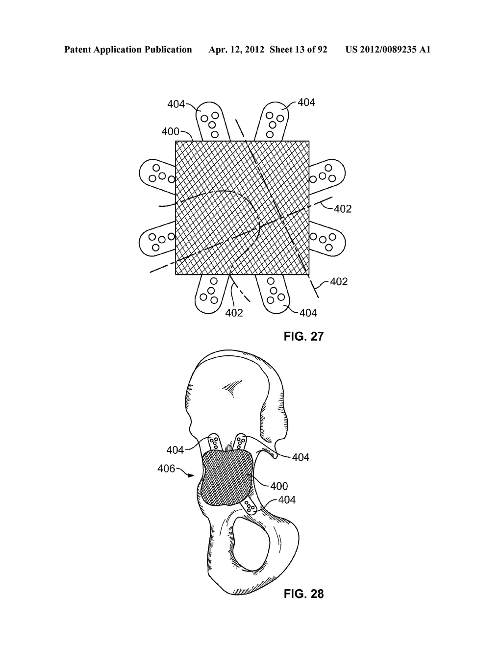 IMPLANT COMPONENTS AND METHODS - diagram, schematic, and image 14