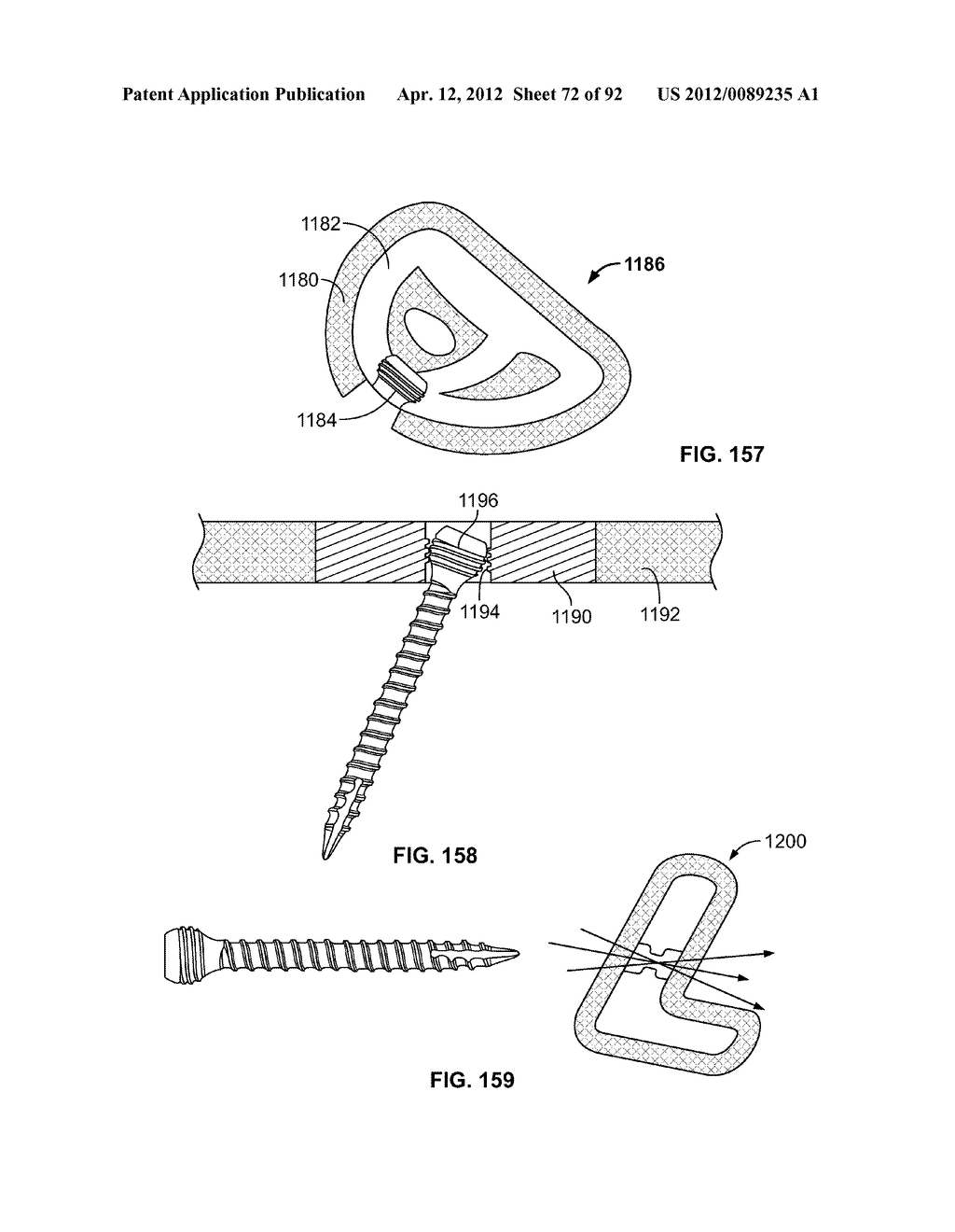 IMPLANT COMPONENTS AND METHODS - diagram, schematic, and image 73