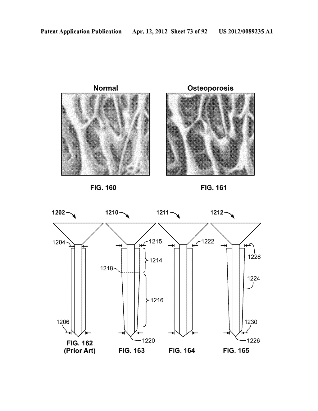 IMPLANT COMPONENTS AND METHODS - diagram, schematic, and image 74