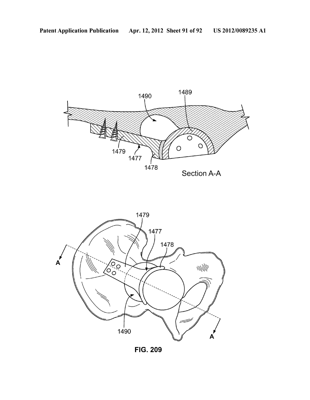 IMPLANT COMPONENTS AND METHODS - diagram, schematic, and image 92