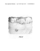 SYSTEMS AND PROCESSES FOR DENTAL IMPLANT PLACEMENT diagram and image