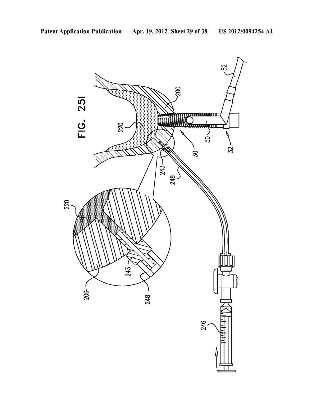 IMPLANTS, TOOLS, AND METHODS FOR SINUS LIFT AND LATERAL RIDGE AUGMENTATION - diagram, schematic, and image 30