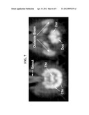 THIOFLAVIN DERIVATES FOR USE IN THE ANTEMORTEM DIAGNOSIS OF ALZHEIMER S     DISEASE AND IN VIVO IMAGING AND PREVENTION OF AMYLOID DEPOSITION diagram and image