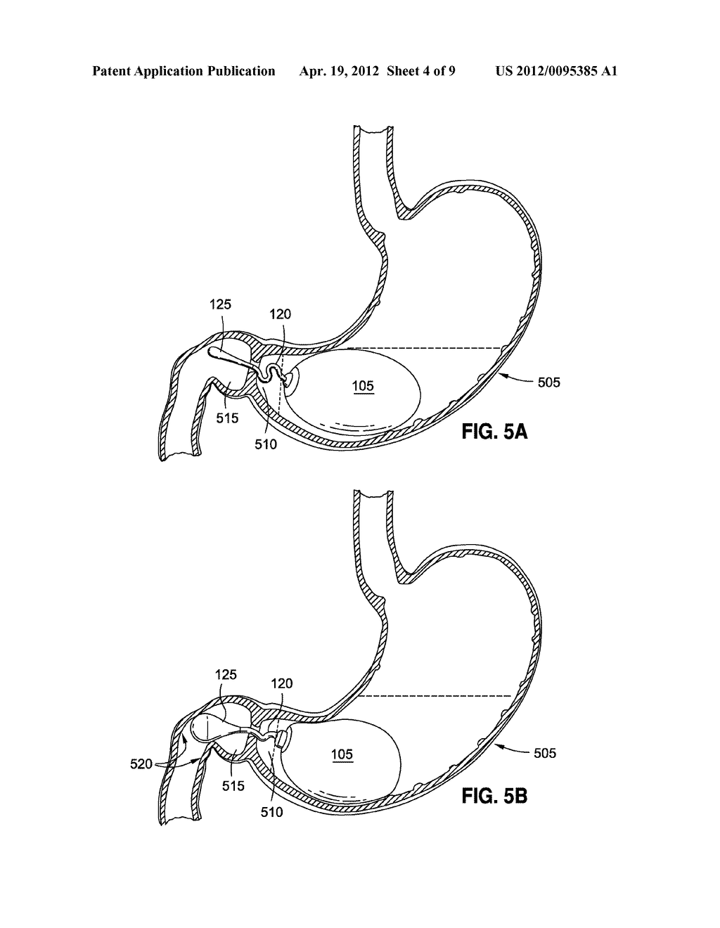 INTRAGASTRIC IMPLANTS WITH DUODENAL ANCHORS - diagram, schematic, and image 05