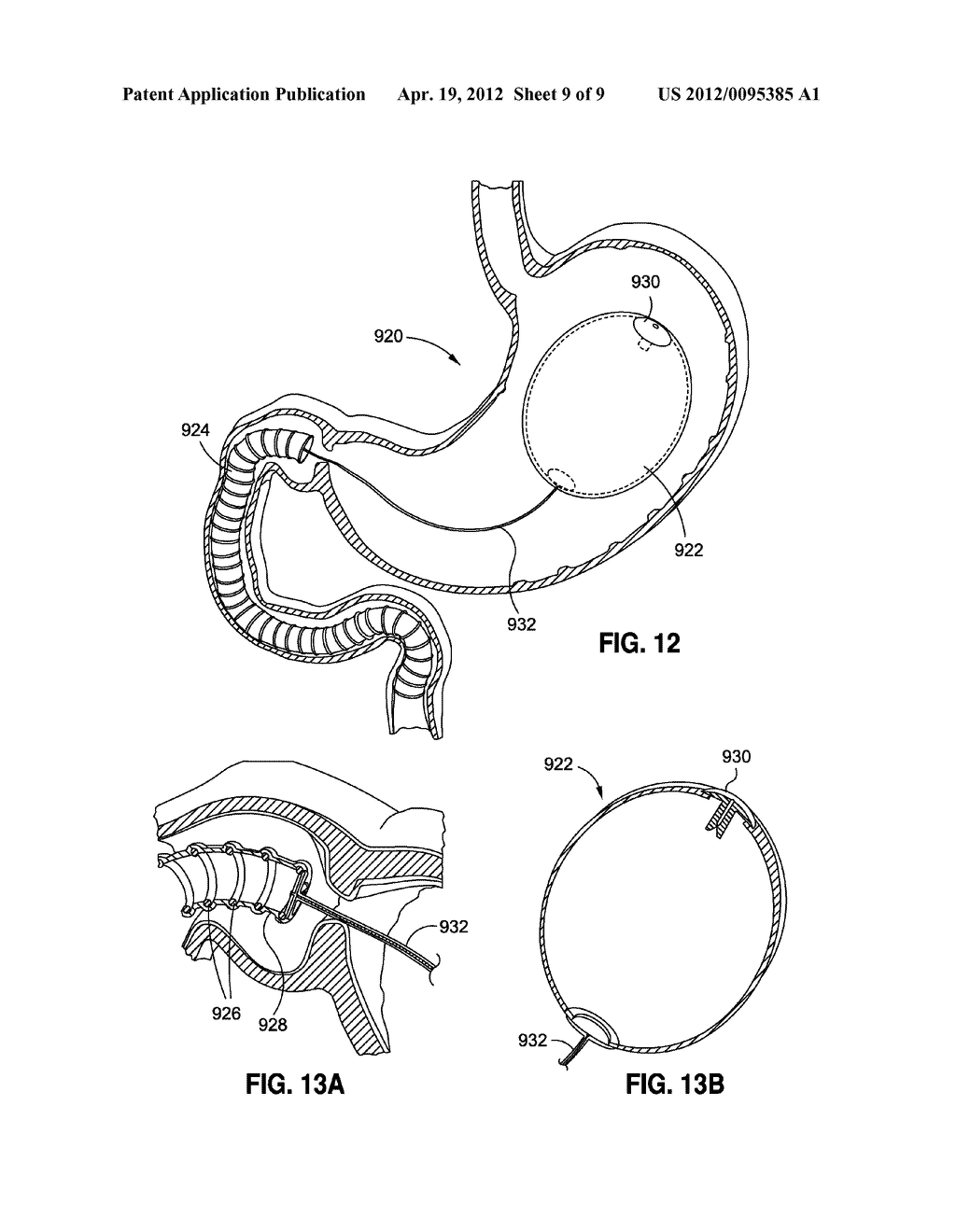 INTRAGASTRIC IMPLANTS WITH DUODENAL ANCHORS - diagram, schematic, and image 10