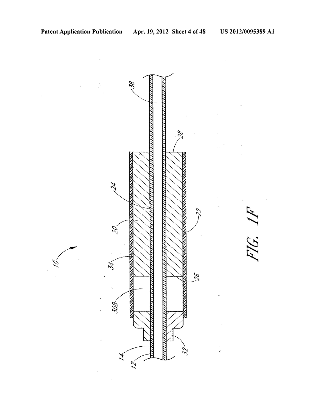 ULTRASOUND CATHETER FOR PROVIDING A THERAPEUTIC EFFECT TO A VESSEL OF A     BODY - diagram, schematic, and image 05