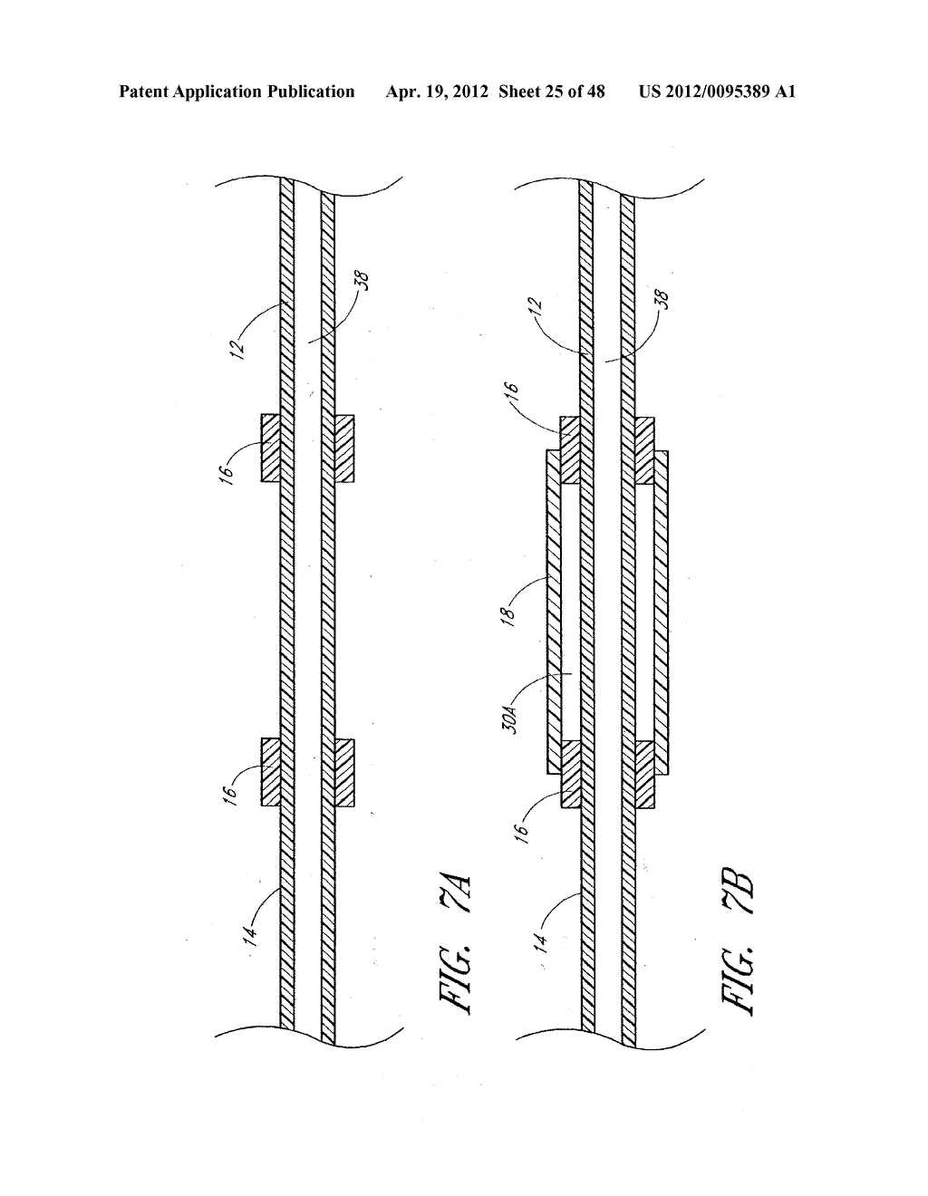 ULTRASOUND CATHETER FOR PROVIDING A THERAPEUTIC EFFECT TO A VESSEL OF A     BODY - diagram, schematic, and image 26