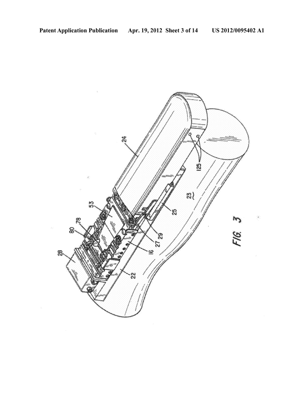 Chronic Access System for Extracorporeal Treatment of Blood Including a     Continuously Wearable Hemodialyzer - diagram, schematic, and image 04