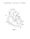 SYSTEM FOR PROVIDING SURGICAL ACCESS diagram and image