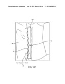 SYSTEM FOR PROVIDING SURGICAL ACCESS diagram and image