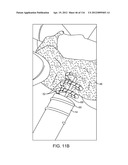 SYSTEM FOR PROVIDING SURGICAL ACCESS diagram and image