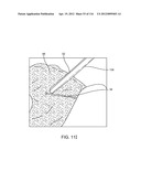 SYSTEM FOR PROVIDING SURGICAL ACCESS diagram and image