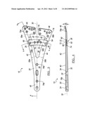 Orthopedic Plate Assembly for a Distal Radius Having Re-Contouring     Features and Method for Using Same diagram and image