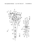 Orthopedic Plate Assembly for a Distal Radius Having Re-Contouring     Features and Method for Using Same diagram and image