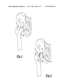 Method and Apparatus for Harvesting Cartilage for Treatment of a Cartilage     Defect diagram and image