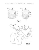 Method and Apparatus for Harvesting Cartilage for Treatment of a Cartilage     Defect diagram and image