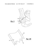 Method and Apparatus for Harvesting Cartilage for Treatment of a Cartilage     Defect diagram and image