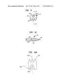 AUTOMATICALLY ADJUSTING PATELLA CUTTING GUIDE diagram and image