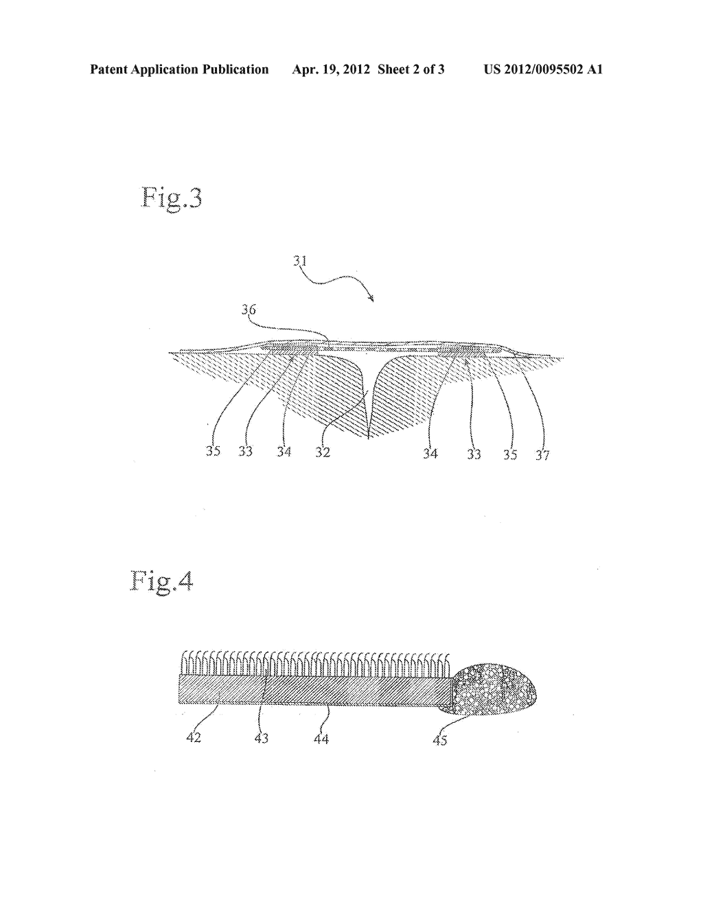 WOUND CLOSURE DEVICE - diagram, schematic, and image 03