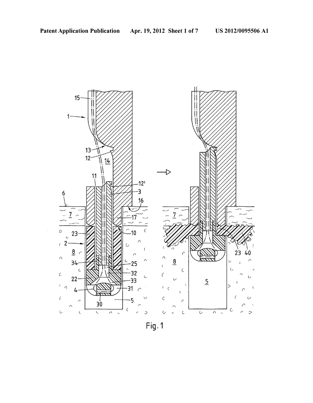 DEVICE AND METHOD FOR FIXATING A SUTURE ANCHOR IN HARD TISSUE - diagram, schematic, and image 02