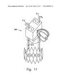 SELF EXPANDABLE MIDDLE EAR IMPLANT FOR TREATING HEARING RELATED DISORDERS diagram and image