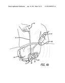 Device For Irradiating An Internal Body Surface diagram and image