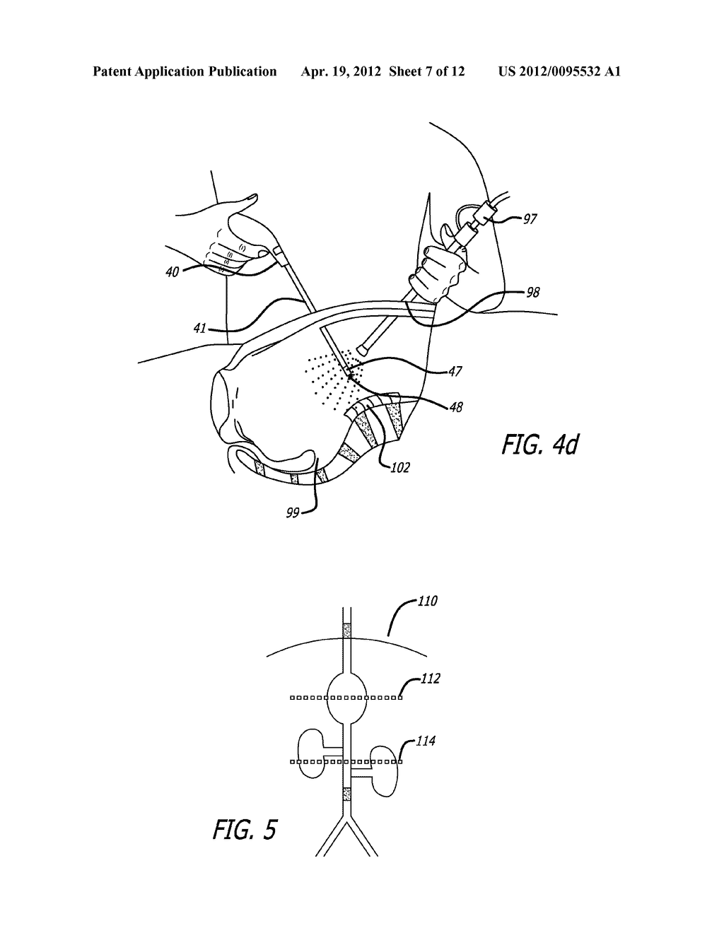 Device For Irradiating An Internal Body Surface - diagram, schematic, and image 08