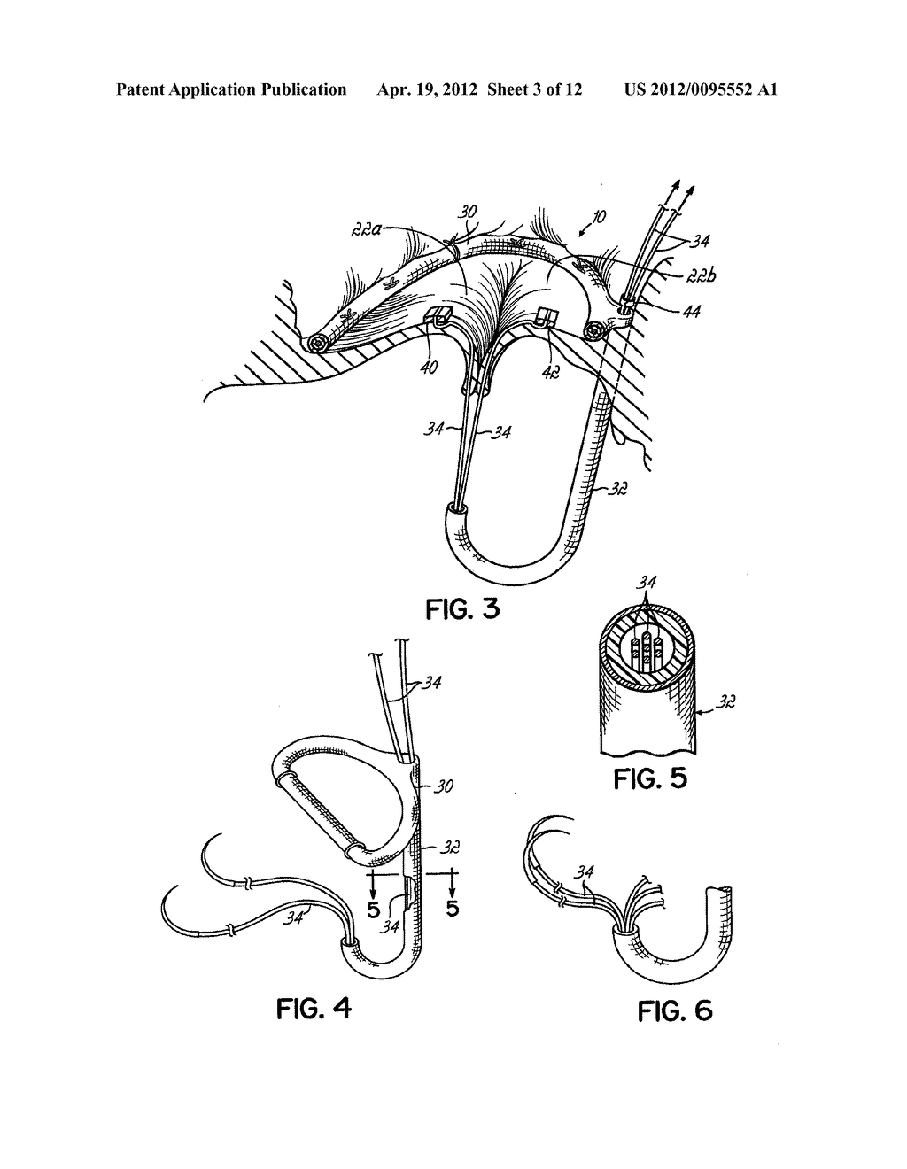 HEART VALVE REPAIR APPARATUS AND METHODS - diagram, schematic, and image 04