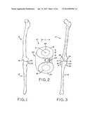 ANTERIOR CRUCIATE LIGAMENT SUBSTITUTING KNEE IMPLANTS diagram and image