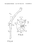 ANTERIOR CRUCIATE LIGAMENT SUBSTITUTING KNEE IMPLANTS diagram and image