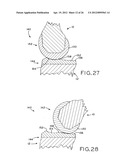 ANTERIOR CRUCIATE LIGAMENT SUBSTITUTING KNEE IMPLANTS diagram and image