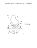 ANTERIOR CRUCIATE LIGAMENT SUBSTITUTING KNEE IMPLANTS diagram and image