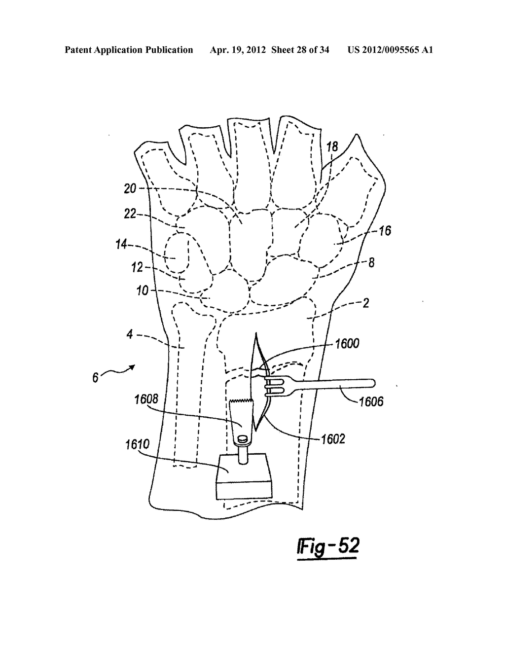 Method And Apparatus For Wrist Arthroplasty - diagram, schematic, and image 29