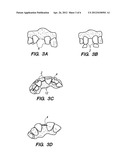 PREFORMED PROVISIONAL CROWNS AND METHODS FOR CONSTRUCTING TEMPORARY DENTAL     CROWNS AND BRIDGES diagram and image
