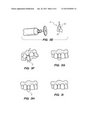 PREFORMED PROVISIONAL CROWNS AND METHODS FOR CONSTRUCTING TEMPORARY DENTAL     CROWNS AND BRIDGES diagram and image