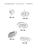 PREFORMED PROVISIONAL CROWNS AND METHODS FOR CONSTRUCTING TEMPORARY DENTAL     CROWNS AND BRIDGES diagram and image