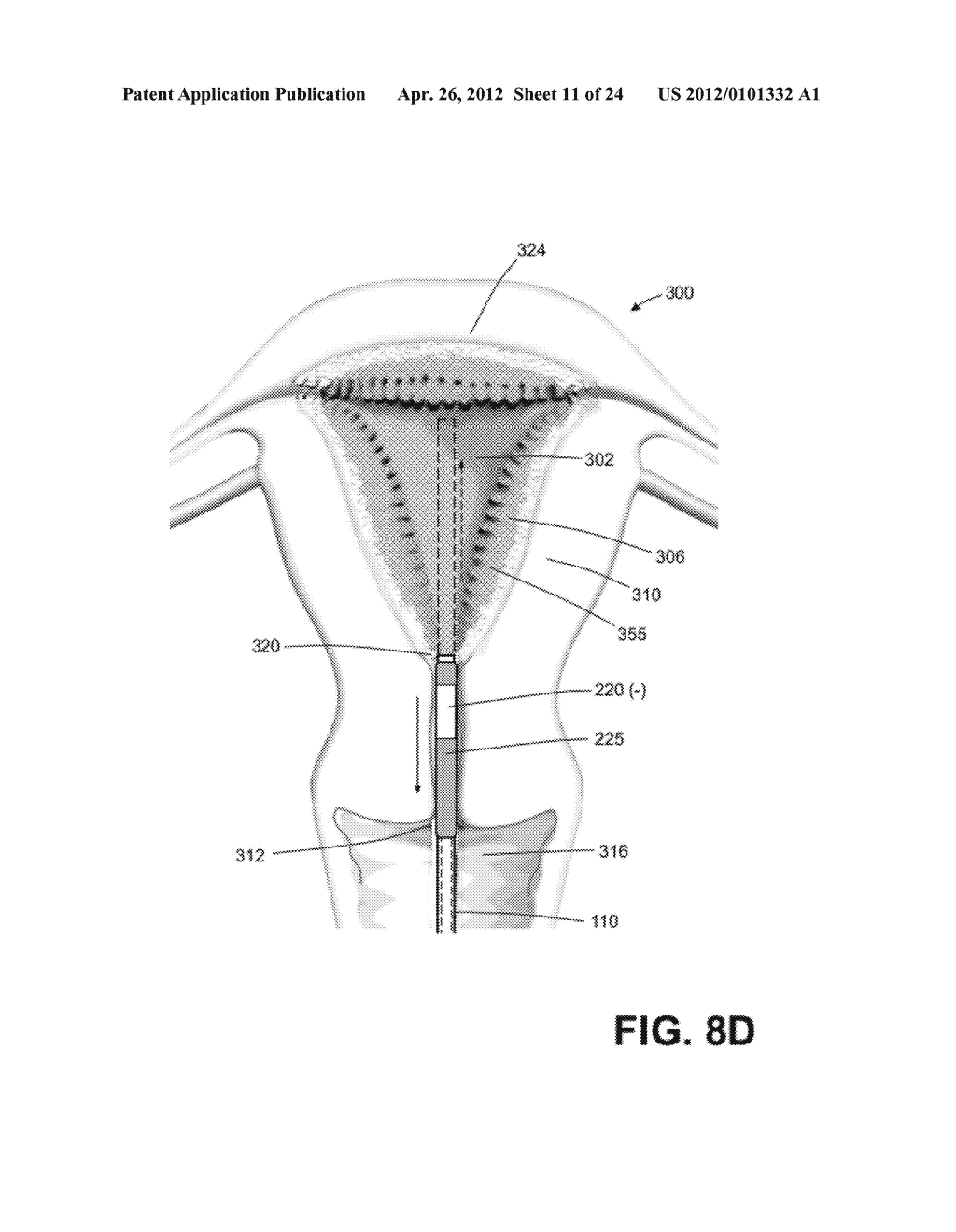 DEVICE FOR ENDOMETRIAL ABLATION HAVING AN EXPANDABLE SEAL FOR A CERVICAL     CANAL - diagram, schematic, and image 12