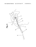 SINUSAL GUIDE CANNULA AND KIT FOR IRRIGATION, SUCTION AND WASHING diagram and image