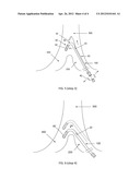 HINGED CATHETER diagram and image