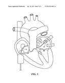 BALLOON CATHETER WITH DEFORMABLE FLUID DELIVERY CONDUIT diagram and image