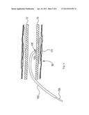 Renal Nerve Ablation Using Conductive Fluid Jet and RF Energy diagram and image