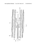 Renal Nerve Ablation Using Conductive Fluid Jet and RF Energy diagram and image