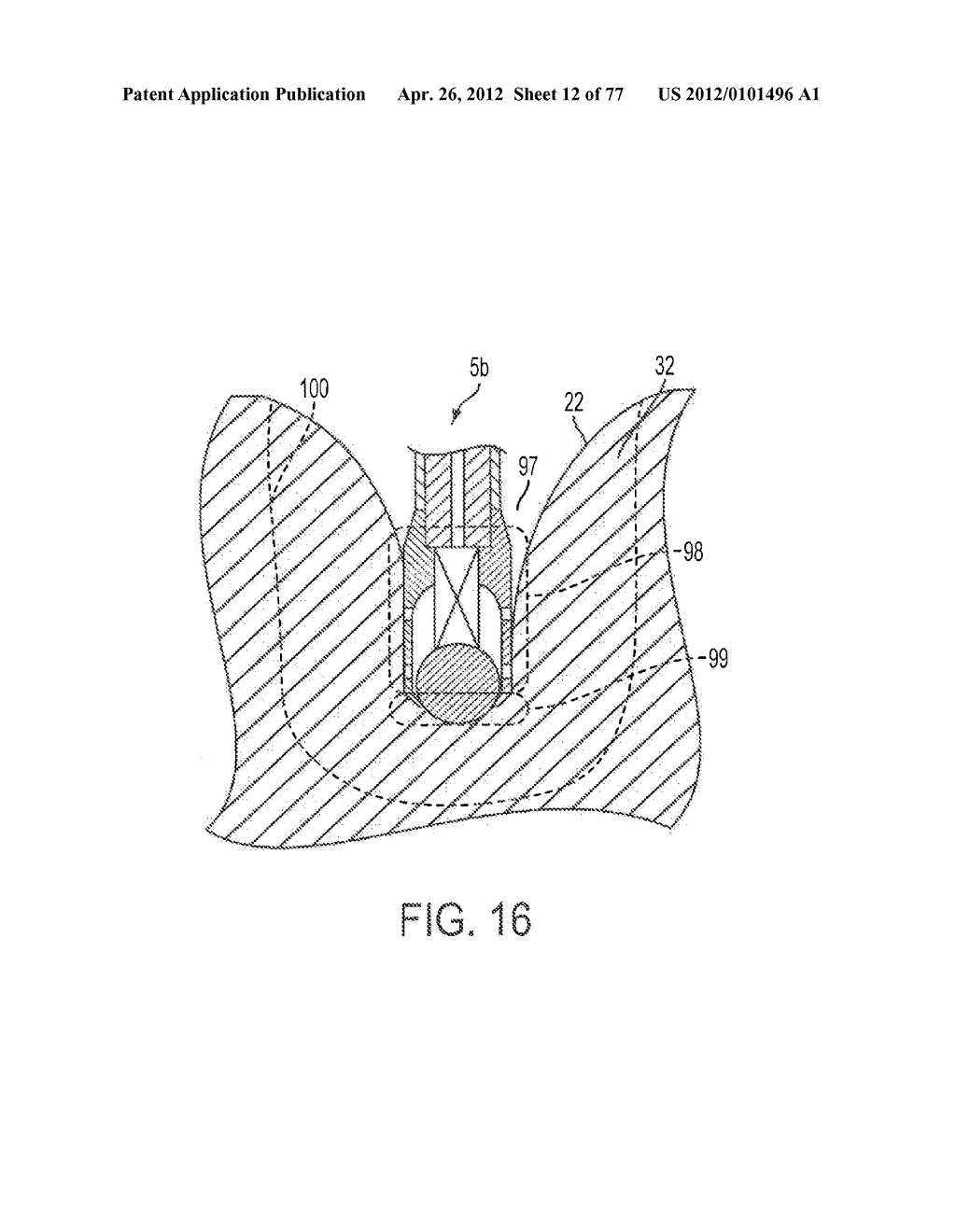 FLUID-ASSISTED MEDICAL DEVICES, SYSTEMS AND METHODS - diagram, schematic, and image 13