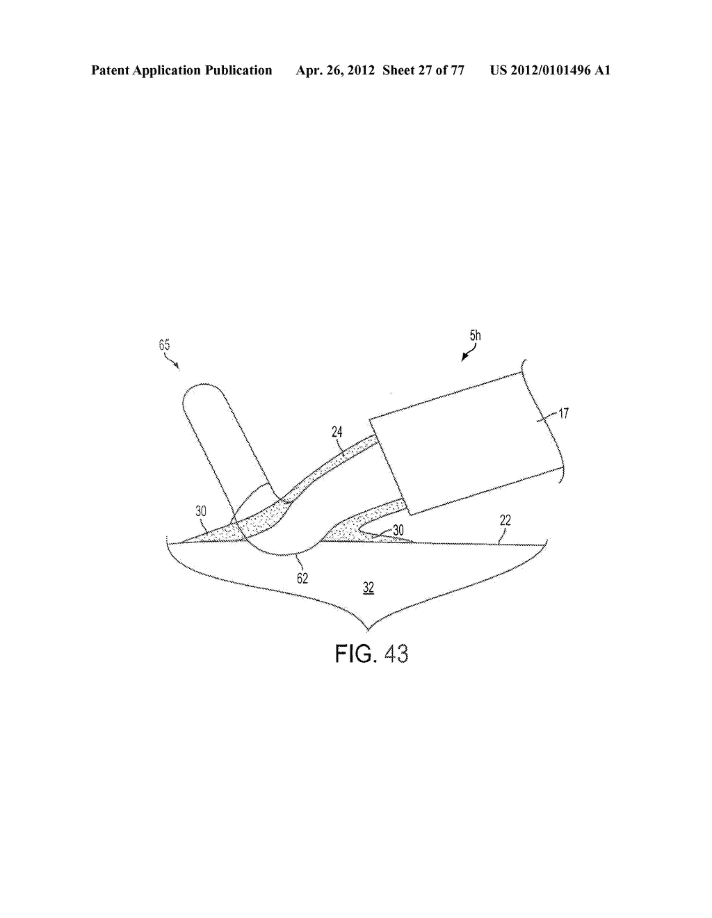 FLUID-ASSISTED MEDICAL DEVICES, SYSTEMS AND METHODS - diagram, schematic, and image 28