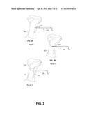 FIXATION AND ALIGNMENT DEVICE AND METHOD USED IN ORTHOPAEDIC SURGERY diagram and image