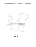 FIXATION AND ALIGNMENT DEVICE AND METHOD USED IN ORTHOPAEDIC SURGERY diagram and image