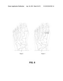 FIXATION AND ALIGNMENT DEVICE AND METHOD USED IN ORTHOPAEDIC SURGERY diagram and image