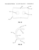 FIXATION AND ALIGNMENT DEVICE AND METHOD USED IN ORTHOPAEDIC SURGERY diagram and image